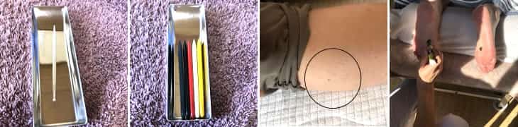 鍼灸の種類写真